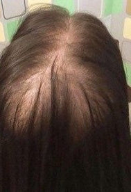 Before - "I can't believe the hair growth...its just amazing. My hair thinning has reduced all thanks to Yohana's products.."