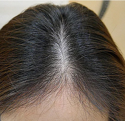 Before - "The results are tooo good.. My scalp is less visible now! Totally worth it. Must try, clean & effective products"