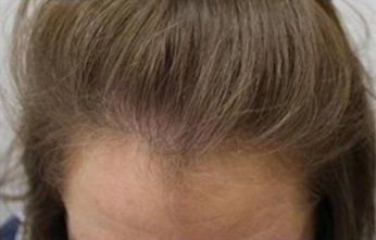 After - "I am very impressed with the results. My lost hair also started to grow. My hair is now healthy and voluminous"