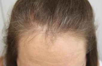Before - "I am very impressed with the results. My lost hair also started to grow. My hair is now healthy and voluminous"