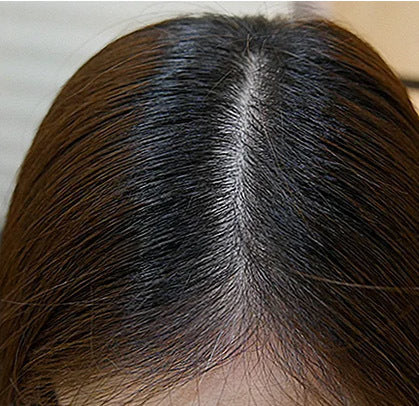 After - "The results are tooo good.. My scalp is less visible now! Totally worth it. Must try, clean & effective products"